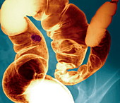 Intestinal parasite,barium X-ray