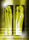 Bunion before and after surgery,X-rays