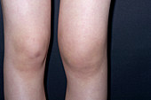 Bursitis of the knee
