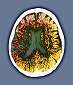Binswanger's disease,CT scan