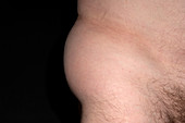 Bursitis of hip joint