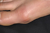 Bursitis of the big toe