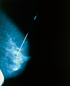 Mammogram of female breast with needle in tumour