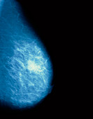Mammogram of a female breast