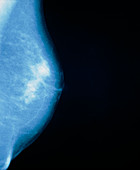 Mammogram of female breast showing a cyst