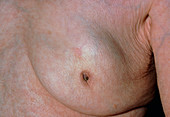 Clinical photo showing a large breast carcinoma