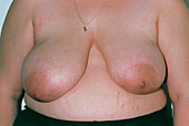 Large asymmetrical breasts in a young woman