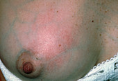 Inflamed breast due to mastitis