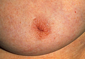 Close-up of the inverted nipple on woman's breast