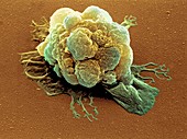 Coloured SEM of a breast cancer cell