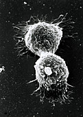 SEM of breast cancer cells dividing