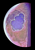 Breast tumour,X-ray