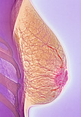 Breast abscess,X-ray