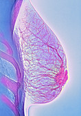 Breast abscess,X-ray