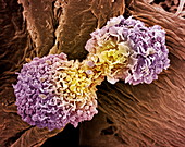 Breast cancer cells,SEM