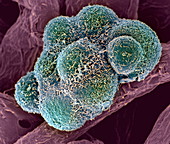 Breast cancer cells,SEM