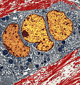 Breast cancer cell,TEM