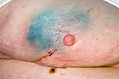 Breast lumpectomy scar