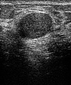 Breast tumour,ultrasound scan