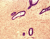 Breast fibroadenoma,light micrograph