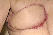 Breast cancer surgery