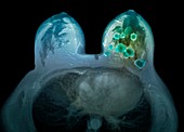 Breast cancer,MRI scan