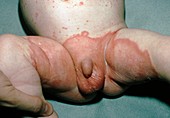 Candidiasis,caused by Candida albicans