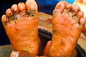 Chigoe fleas in feet of a three year old
