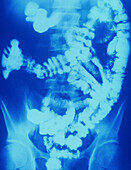 X-ray of the lower gut in Crohn's disease