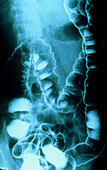 Double-contrast X-ray in Crohn's disease