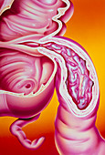 Illustration of Crohn's disease of the ileum
