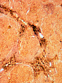 LM of a section of liver showing cirrhosis