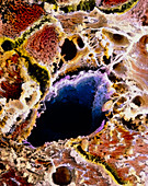 Liver cells with cirrhosis,SEM