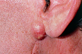 Infected sebaceous cyst on man's jaw (under ear)