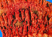 Excised human colon showing ulcerative colitis