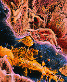 Coloured SEM of a liver cell affected by cirrhosis