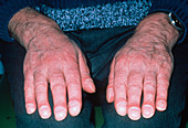 Clubbing (acropachy) of finger tips