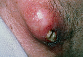 Burst infected sebaceous cyst on patient's neck