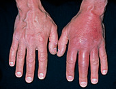 Inflammation of hand due to cellulitis