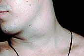 Branchial cyst on neck of 18-year-old man