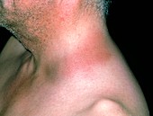 Cellulitis on the neck of a 40-year-old man