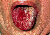 Tongue of elderly woman with oral candidiasis