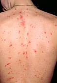 Chickenpox on the back of a 19 year-old man