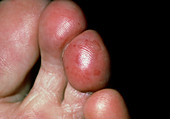 Chilblain on the toe of 35 year-old female patient