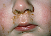 Rhinitis: mucus & pus discharge from child's nose