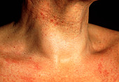 Swollen neck of man with benign thyroid cyst