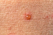Close-up of a chickenpox vesicle (lesion) on skin