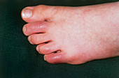 Chilblains on the toes of a six-year-old girl