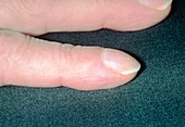 Clubbing (acropachy) of fingers from renal failure