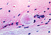LM of mouse brain infected with new variant CJD